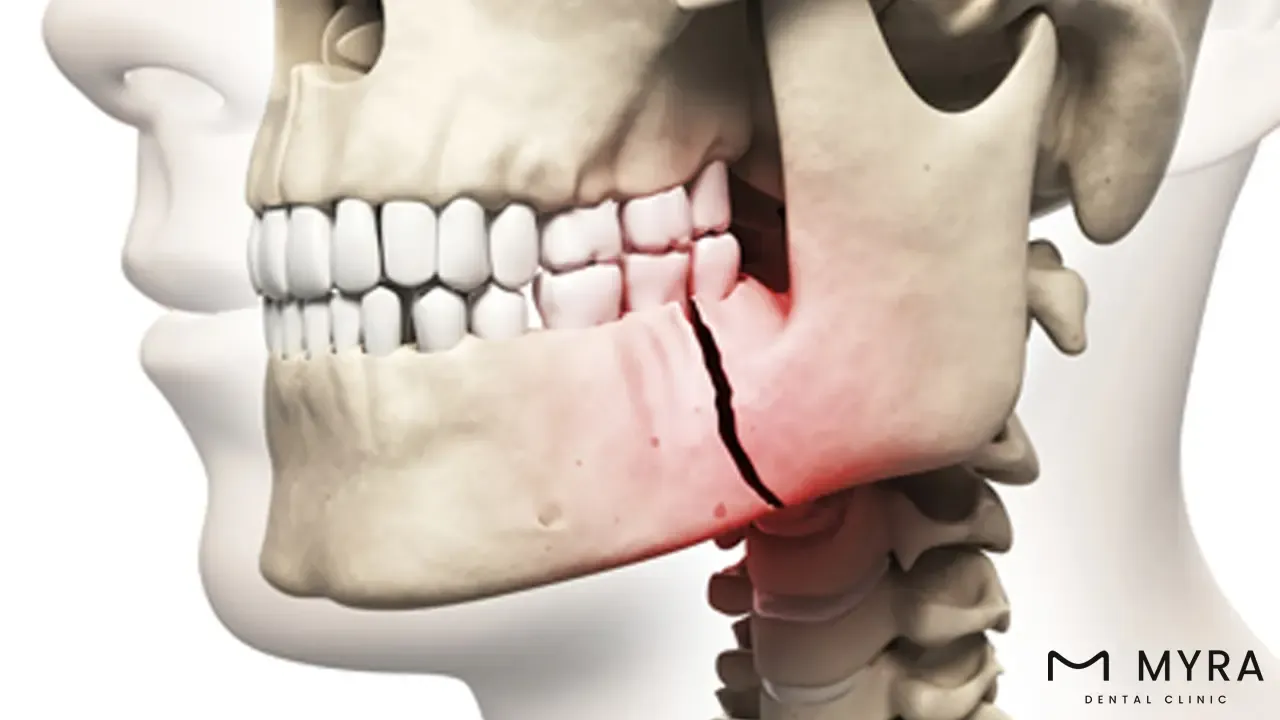 jaw bone damage.webp